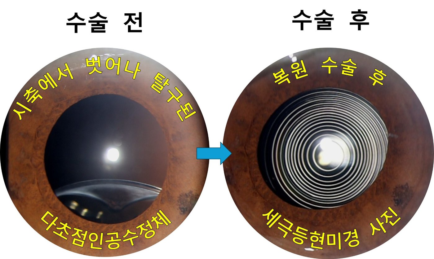 시축에서 벗어난 다초점 인공수정체를 복원한 수술 전후 비교 사진